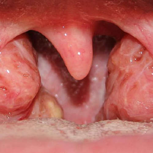 Tonsil Hipertrofisi