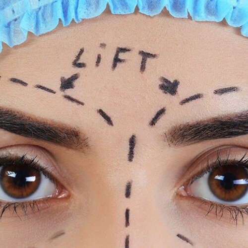Browlift
