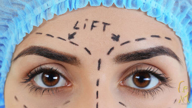 Browlift