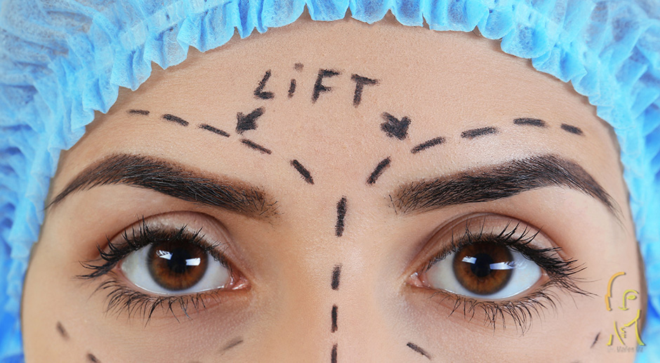 Browlift