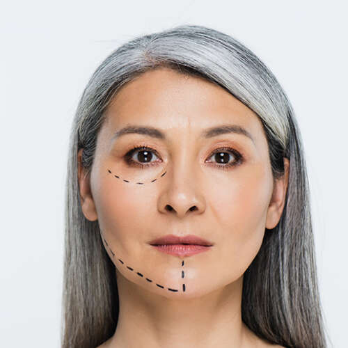 Face lift