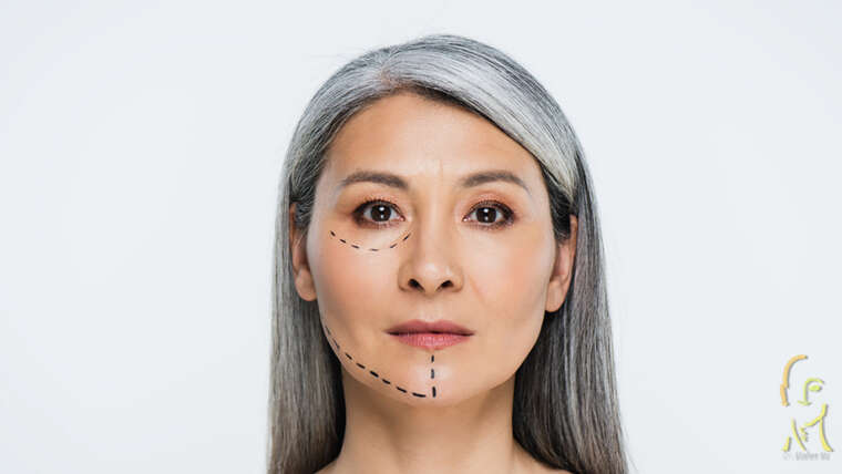 Face lift
