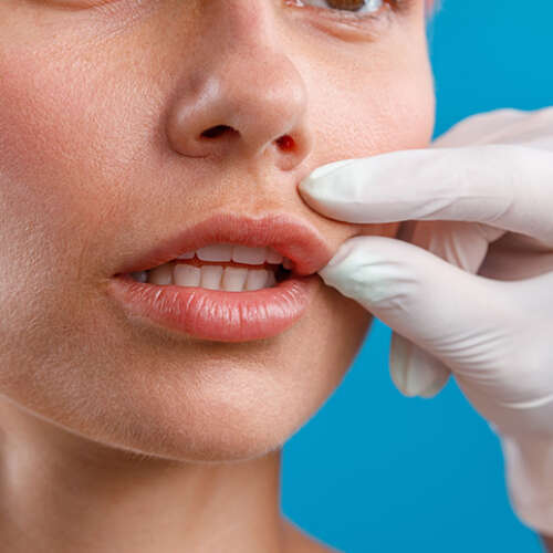 Lip lift, dudak kaldırma